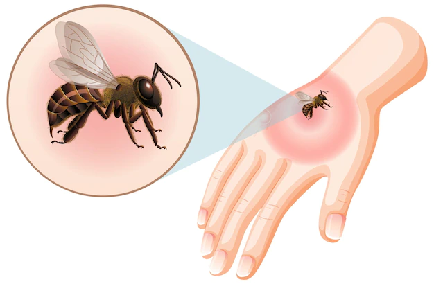 Böcek sokmaları: belirtiler, alerjiler ve merhemler